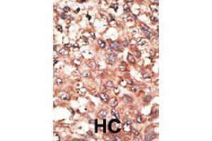 Formalin-fixed and paraffin-embedded human hepatocellular carcinoma tissue reacted with BMP5 polyclonal antibody  , which was peroxidase-conjugated to the secondary antibody, followed by AEC staining. (BMP5 Antikörper  (N-Term))