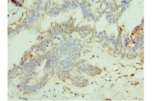 Immunohistochemistry of paraffin-embedded human breast cancer using ABIN7159998 at dilution of 1:100 (MAPK15 Antikörper  (AA 1-95))