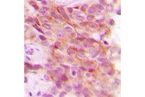 Immunohistochemical analysis of PSMD12 staining in human breast cancer formalin fixed paraffin embedded tissue section.