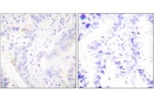 Immunohistochemistry analysis of paraffin-embedded human lung carcinoma tissue, using CrkII (Ab-221) Antibody. (Crk Antikörper  (AA 187-236))