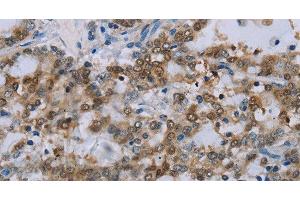 Immunohistochemistry of paraffin-embedded Human liver cancer tissue using MED12 Polyclonal Antibody at dilution 1:40 (MED12 Antikörper)