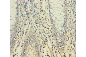 Immunohistochemistry of paraffin-embedded human colon cancer using ABIN7166354 at dilution of 1:100 (YPEL1 Antikörper  (AA 1-119))