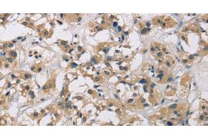Immunohistochemistry of paraffin-embedded Human thyroid cancer using CYR61 Polyclonal Antibody at dilution of 1:60