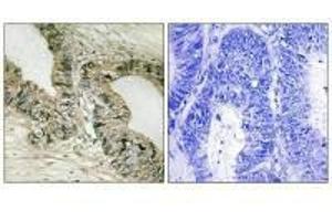 Immunohistochemistry analysis of paraffin-embedded human colon carcinoma tissue using GRB2 (Ab-159) antibody. (GAB2 Antikörper  (Ser159))