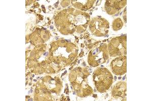 Immunohistochemistry of paraffin-embedded Human gastric using Tp53 antibody at dilution of 1:100 (x400 lens). (p53 Antikörper)