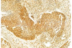 ABIN6262106 and ABIN6273119 at 1/100 staining Human lung cancer by IHC-P. (GSDMD Antikörper)