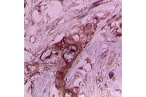 Immunohistochemical analysis of Collagen 2 alpha 1 staining in human breast cancer formalin fixed paraffin embedded tissue section.