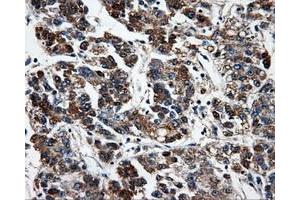 Immunohistochemical staining of paraffin-embedded Carcinoma of liver tissue using anti-FAHD2Amouse monoclonal antibody. (FAHD2A Antikörper)