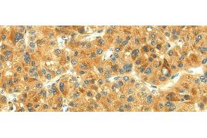 Immunohistochemistry of paraffin-embedded Human liver cancer using THAP3 Polyclonal Antibody at dilution of 1/30 (THAP3 Antikörper)