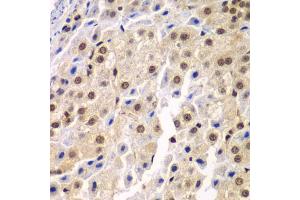Immunohistochemistry of paraffin-embedded human liver cancer using SF3B2 antibody (ABIN5973482) at dilution of 1/100 (40x lens). (SF3B2 Antikörper)