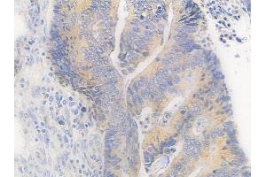 ABIN6260388 and ABIN6279218 at 1/100 staining human colon carcinoma by IHC-P. (CABP1 Antikörper  (Internal Region))