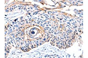The image on the left is immunohistochemistry of paraffin-embedded Human esophagus cancer tissue using ABIN7190097(CCNB2 Antibody) at dilution 1/10, on the right is treated with synthetic peptide. (Cyclin B2 Antikörper)