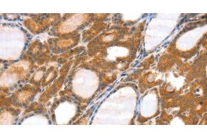 Immunohistochemistry of paraffin-embedded Human thyroid cancer tissue using SRGAP3 Polyclonal Antibody at dilution 1:40 (SRGAP3 Antikörper)