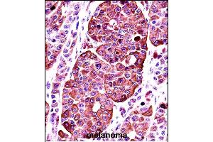 TYR Antibody (Center) ((ABIN391521 and ABIN2841481))immunohistochemistry analysis in formalin fixed and paraffin embedded human melanoma followed by peroxidase conjugation of the secondary antibody and DAB staining. (TYR Antikörper  (AA 176-205))