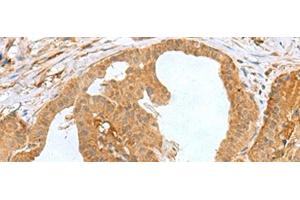 Immunohistochemistry of paraffin-embedded Human thyroid cancer tissue using MRPS28 Polyclonal Antibody at dilution of 1:60(x200) (MRPS28 Antikörper)