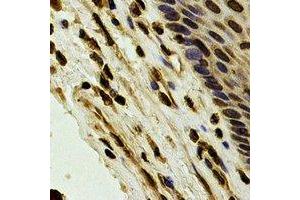 Immunohistochemical analysis of Karyopherin alpha-4 staining in human esophageal cancer formalin fixed paraffin embedded tissue section. (KPNA4 Antikörper)