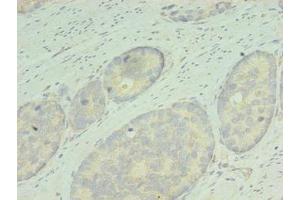 Immunohistochemistry of paraffin-embedded human gastric cancer using ABIN7167836 at dilution of 1:100 (RDH12 Antikörper  (AA 1-316))