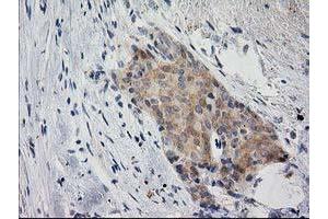 Immunohistochemical staining of paraffin-embedded Adenocarcinoma of Human breast tissue using anti-EIF4E2 mouse monoclonal antibody. (EIF4E2 Antikörper)