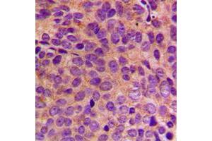 Immunohistochemical analysis of Cytokeratin 18 staining in human breast cancer formalin fixed paraffin embedded tissue section. (Cytokeratin 18 Antikörper  (C-Term))