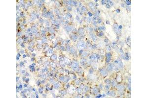 Immunohistochemistry of paraffin-embedded Human esophageal cancer using PRKCQ Polyclonal Antibody at dilution of 1:200 (40x lens).