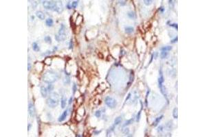 IHC analysis of FFPE human breast carcinoma tissue stained with the PDGFRL antibody (PDGFRL Antikörper  (AA 328-357))