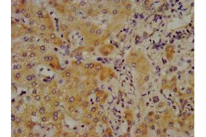 IHC image of ABIN7148361 diluted at 1:700 and staining in paraffin-embedded human liver cancer performed on a Leica BondTM system. (C4A Antikörper  (AA 1027-1186))