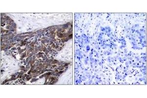 Immunohistochemistry analysis of paraffin-embedded human breast carcinoma, using Connexin 43 (Phospho-Ser367) Antibody. (Connexin 43/GJA1 Antikörper  (pSer367))