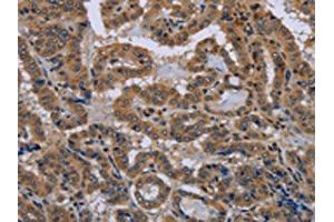 The image on the left is immunohistochemistry of paraffin-embedded Human thyroid cancer tissue using (NPHS2 Antibody) at dilution 1/40, on the right is treated with synthetic peptide. (Podocin Antikörper)
