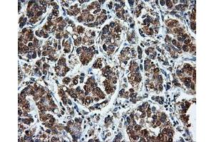 Immunohistochemical staining of paraffin-embedded Carcinoma of liver tissue using anti-LEMD3mouse monoclonal antibody. (LEMD3 Antikörper)