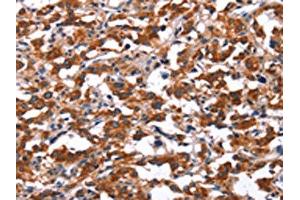 The image on the left is immunohistochemistry of paraffin-embedded Human thyroid cancer tissue using ABIN7191188(KCNJ9 Antibody) at dilution 1/15, on the right is treated with synthetic peptide. (KCNJ9 Antikörper)