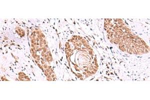 Immunohistochemistry of paraffin-embedded Human esophagus cancer tissue using RUVBL1 Polyclonal Antibody at dilution of 1:85(x200) (RUVBL1 Antikörper)