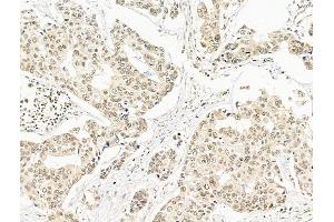 ABIN7094796 and ABIN7098847 at 1/100 staining Human breast cancer by IHC-P. (SF3B1 Antikörper  (N-Term))