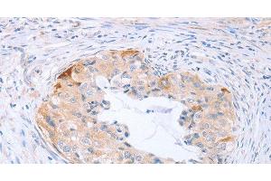 Immunohistochemistry of paraffin-embedded Human cervical cancer tissue using CARD6 Polyclonal Antibody at dilution 1:60 (CARD6 Antikörper)