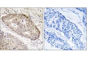 Immunohistochemistry analysis of paraffin-embedded human lung carcinoma tissue, using ALS2CR8 Antibody. (Calcium Responsive Transcription Factor (CARF) (AA 311-360) Antikörper)