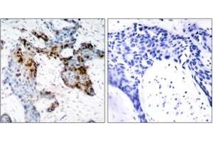 Immunohistochemistry analysis of paraffin-embedded human breast carcinoma tissue, using Estrogen Receptor-alpha (Ab-118) Antibody. (Estrogen Receptor alpha Antikörper  (AA 91-140))