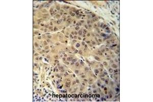 BUD13 antibody (C-term) (ABIN654718 and ABIN2844407) immunohistochemistry analysis in formalin fixed and paraffin embedded human hepatocarcinoma followed by peroxidase conjugation of the secondary antibody and DAB staining. (BUD13 Antikörper  (C-Term))