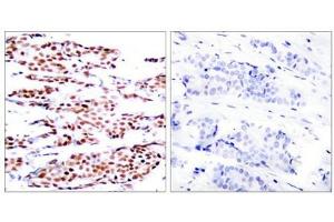 Immunohistochemical analysis of paraffin-embedded human breast carcinoma tissue using JunB(Phospho-Ser79) Antibody(left) or the same antibody preincubated with blocking peptide(right). (JunB Antikörper  (pSer79))