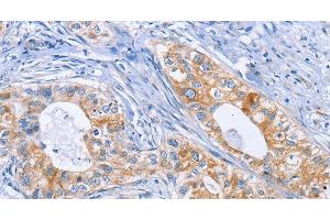 Immunohistochemistry of paraffin-embedded Human cervical cancer tissue using DOK4 Polyclonal Antibody at dilution 1:50 (DOK4 Antikörper)