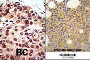 Formalin-fixed and paraffin-embedded human prostata carcinoma tissue reacted with PRMT3 Antibody , which was peroxidase-conjugated to the secondary antibody, followed by DAB staining. (PRMT3 Antikörper  (C-Term))