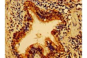Immunohistochemistry of paraffin-embedded human lung cancer using ABIN7155006 at dilution of 1:100