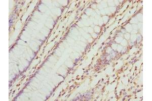 Immunohistochemistry of paraffin-embedded human colon cancer using ABIN7173063 at dilution of 1:100 (TMEM143 Antikörper  (AA 8-278))