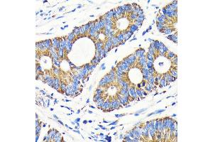 Immunohistochemistry of paraffin-embedded human colon carcinoma using VD antibody (ABIN7271335) at dilution of 1:100 (40x lens). (VDAC1 Antikörper)