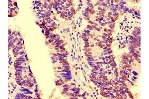 Immunohistochemistry of paraffin-embedded human colon cancer using ABIN7161302 at dilution of 1:100 (NOTCH3 Antikörper  (AA 1301-1496))