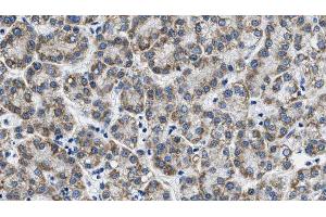 ABIN6268770 at 1/100 staining Human liver cancer tissue by IHC-P. (AQP3 Antikörper  (Internal Region))