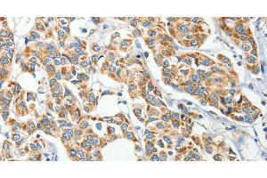 Immunohistochemistry of paraffin-embedded Human breast cancer tissue using IFT74 Polyclonal Antibody at dilution 1:60 (IFT74 Antikörper)