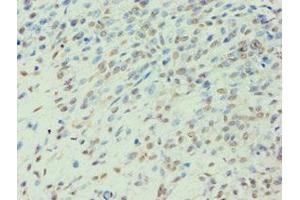 Immunohistochemistry of paraffin-embedded human breast cancer using ABIN7141988 at dilution of 1:100 (BCKDK Antikörper  (AA 153-412))