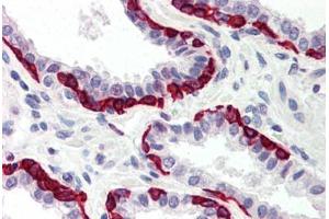 Human Prostate (formalin-fixed, paraffin-embedded) stained with DAPK2 antibody ABIN214481 at 5 ug/ml followed by biotinylated goat anti-rabbit IgG secondary antibody ABIN481713, alkaline phosphatase-streptavidin and chromogen. (DAPK2 Antikörper  (C-Term))