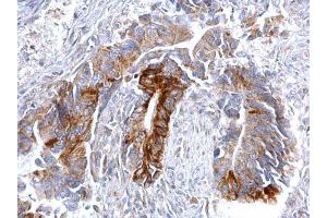 IHC-P Image CCR3 antibody [C2C3], C-term detects CCR3 protein at cytosol on human colon carcinoma by immunohistochemical analysis. (CCR3 Antikörper  (C-Term))