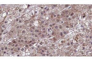 ABIN6277456 at 1/100 staining Human liver cancer tissue by IHC-P.