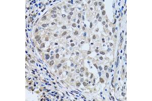 Immunohistochemistry of paraffin-embedded human lung cancer using LSM4 antibody (ABIN5973492) at dilution of 1/100 (40x lens). (LSM4 Antikörper)